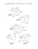 DEVICE WITH ACTIVE VALVE TO BLOCK EMESIS AND REFLUX BLOCKAGE DEVICE AND     ASSOCIATED SYSTEM AND METHOD diagram and image