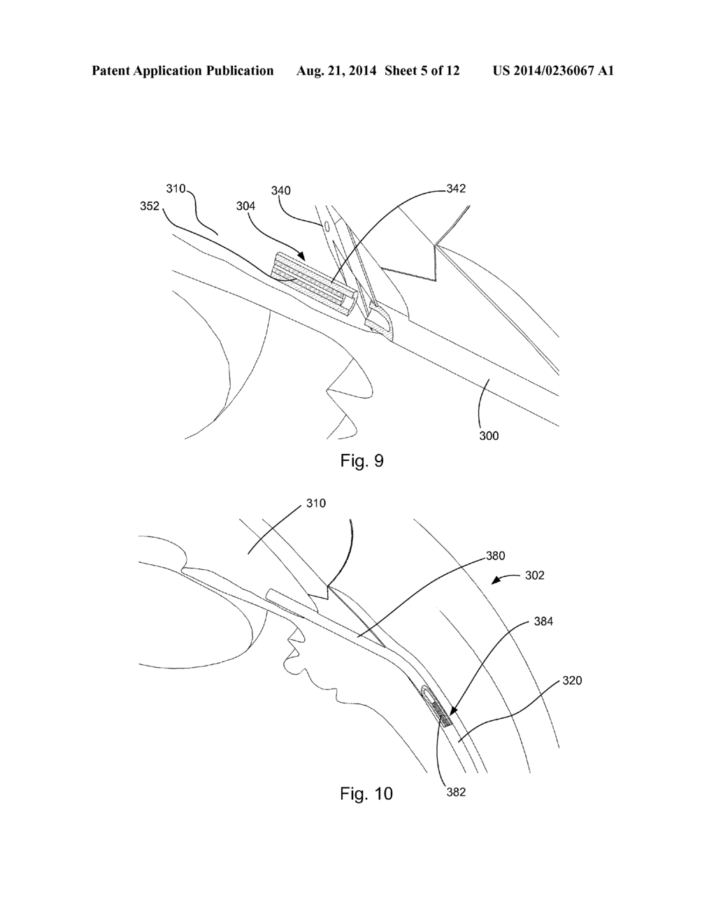 ADJUSTABLE GLAUCOMA IMPLANT - diagram, schematic, and image 06