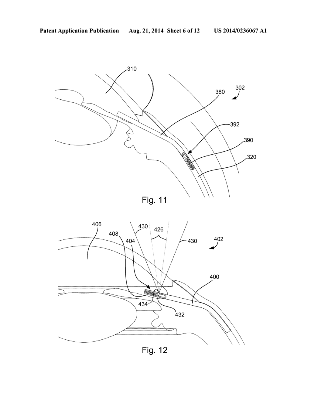 ADJUSTABLE GLAUCOMA IMPLANT - diagram, schematic, and image 07