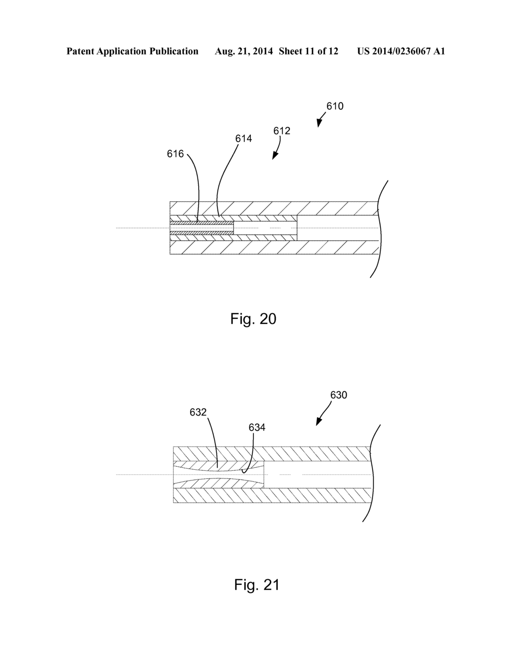 ADJUSTABLE GLAUCOMA IMPLANT - diagram, schematic, and image 12