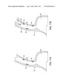 Expandable Mesh Platform for Large Area Ablation diagram and image