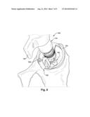 APPARATUS AND METHOD FOR AIDING VISUALIZATION AND/OR PLACING A LANDMARK     DURING A SURGICAL PROCEDURE diagram and image