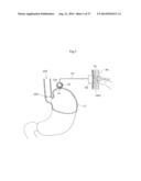 DEVICE FOR TREATING OBESITY diagram and image