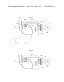 DEVICE FOR TREATING OBESITY diagram and image