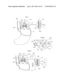 DEVICE FOR TREATING OBESITY diagram and image