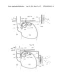 DEVICE FOR TREATING OBESITY diagram and image