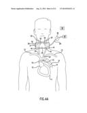 Anti-Embolic Device and Method diagram and image