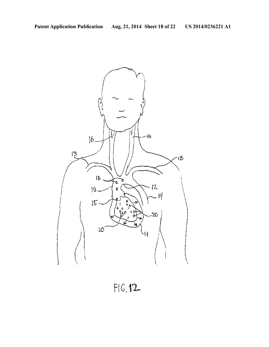 Anti-Embolic Device and Method - diagram, schematic, and image 19