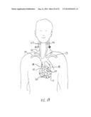 Anti-Embolic Device and Method diagram and image