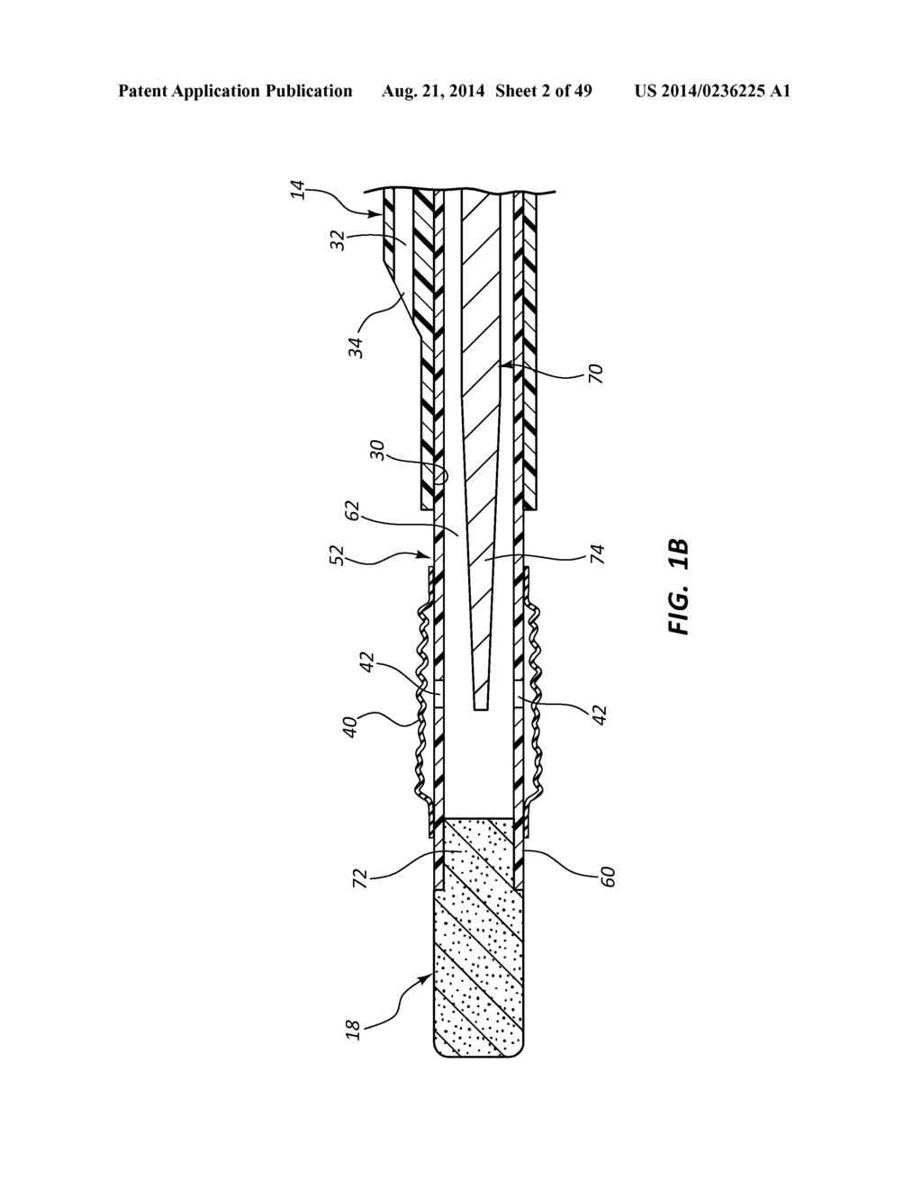 BIOADHESIVE DELIVERY SYSTEMS AND METHODS FOR VASCULAR CLOSURE - diagram, schematic, and image 03