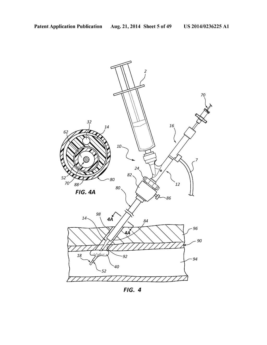 BIOADHESIVE DELIVERY SYSTEMS AND METHODS FOR VASCULAR CLOSURE - diagram, schematic, and image 06