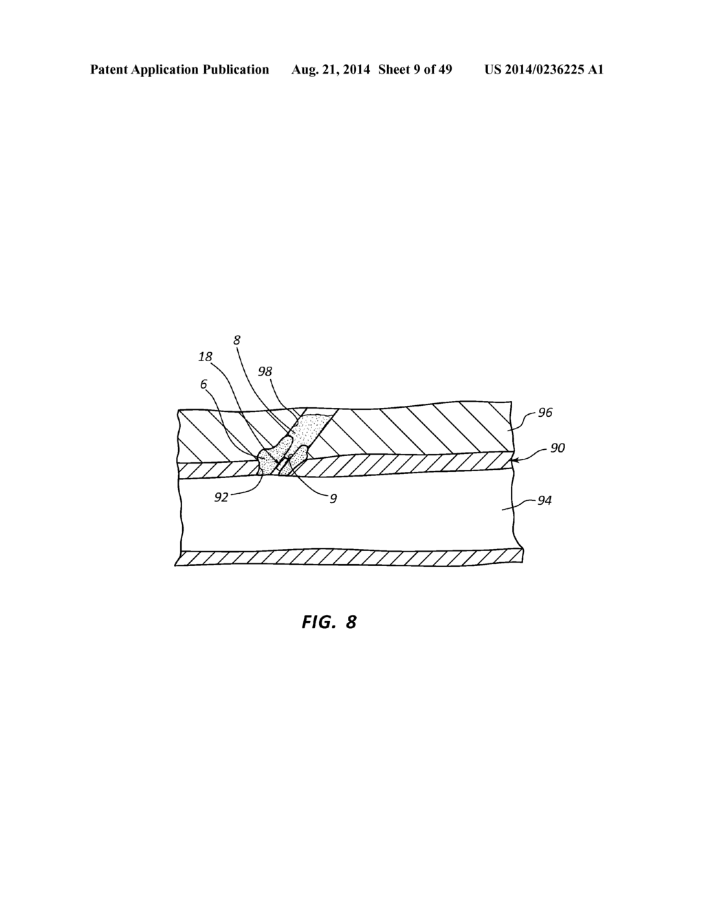 BIOADHESIVE DELIVERY SYSTEMS AND METHODS FOR VASCULAR CLOSURE - diagram, schematic, and image 10