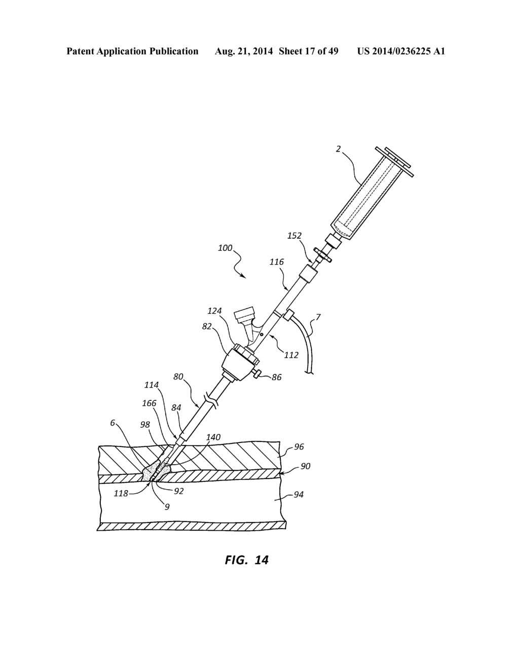 BIOADHESIVE DELIVERY SYSTEMS AND METHODS FOR VASCULAR CLOSURE - diagram, schematic, and image 18