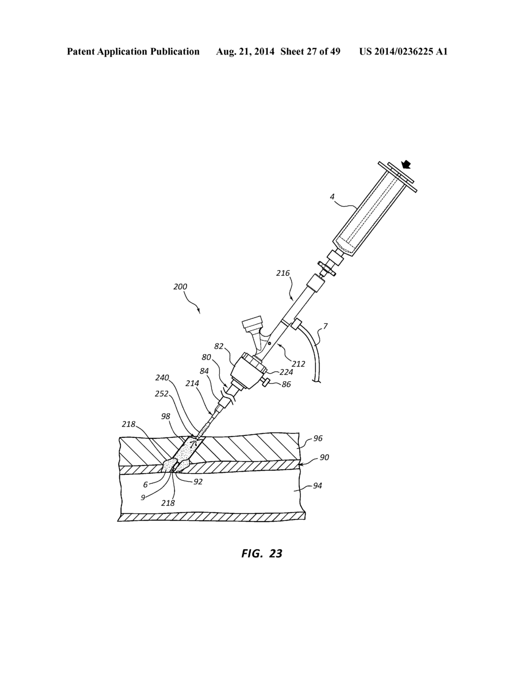 BIOADHESIVE DELIVERY SYSTEMS AND METHODS FOR VASCULAR CLOSURE - diagram, schematic, and image 28