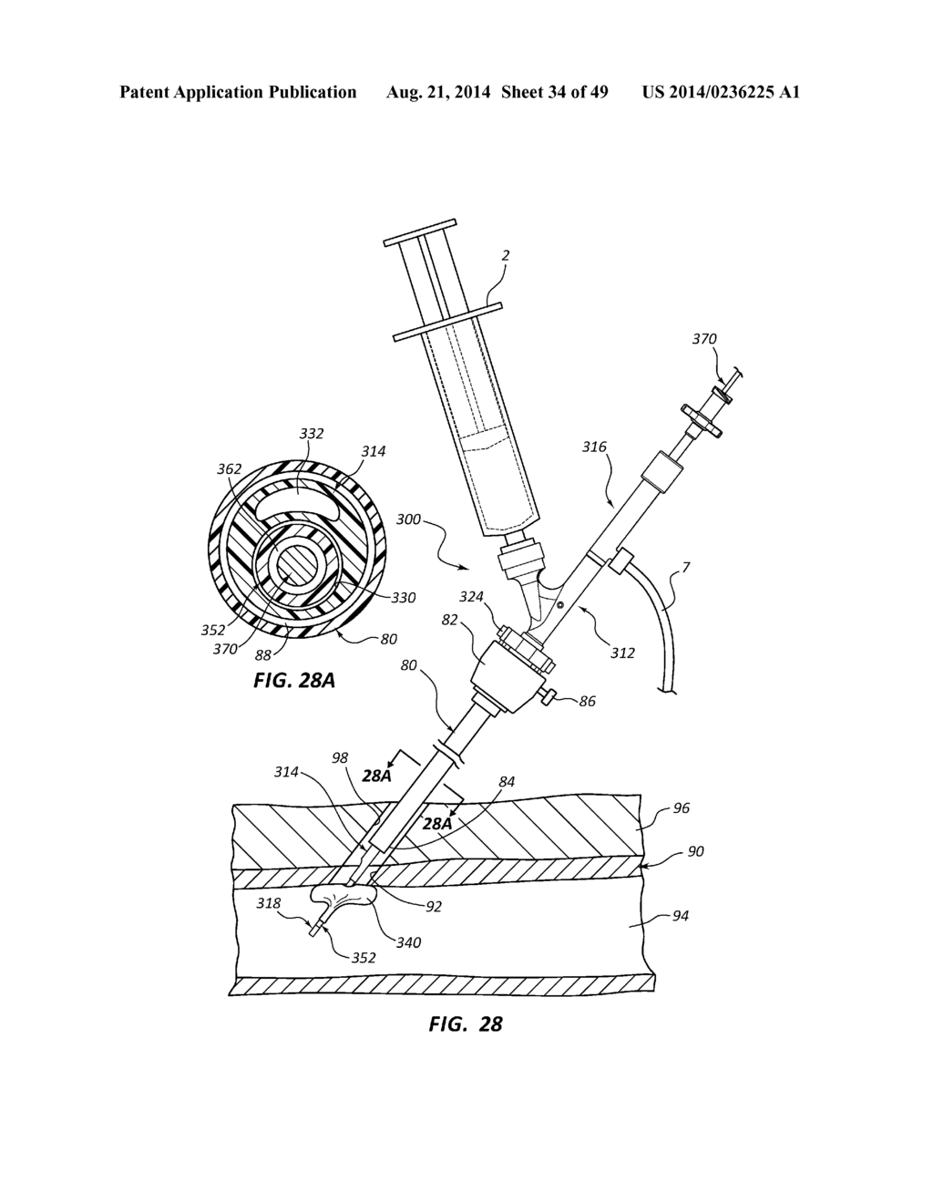 BIOADHESIVE DELIVERY SYSTEMS AND METHODS FOR VASCULAR CLOSURE - diagram, schematic, and image 35