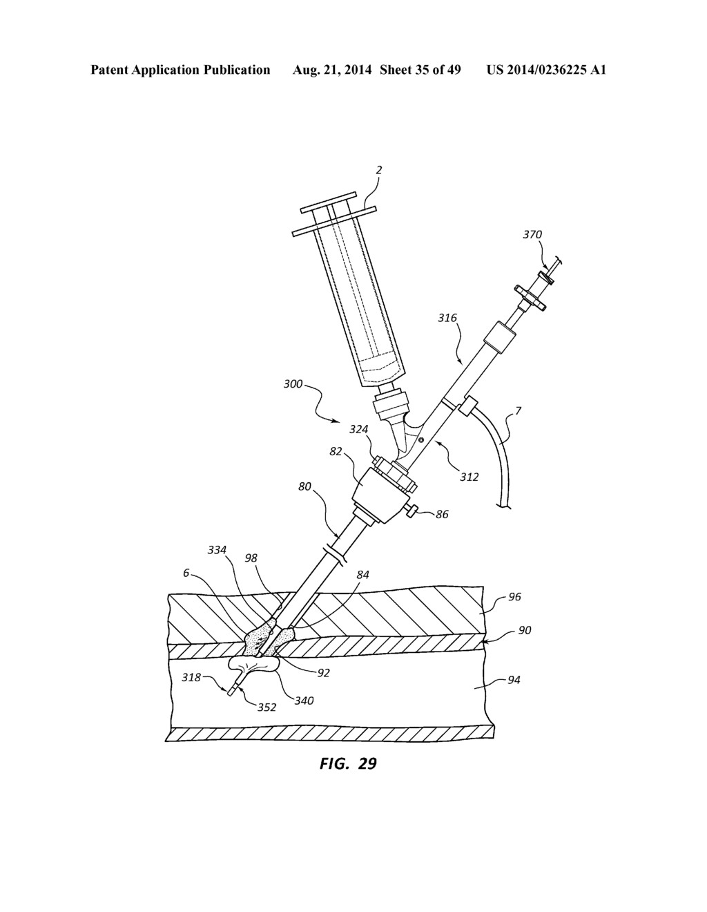 BIOADHESIVE DELIVERY SYSTEMS AND METHODS FOR VASCULAR CLOSURE - diagram, schematic, and image 36