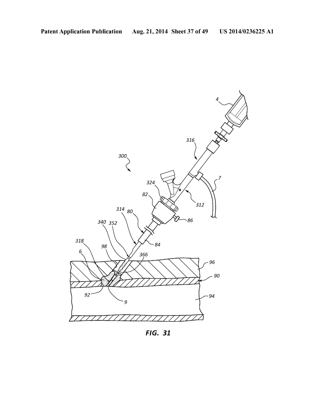 BIOADHESIVE DELIVERY SYSTEMS AND METHODS FOR VASCULAR CLOSURE - diagram, schematic, and image 38