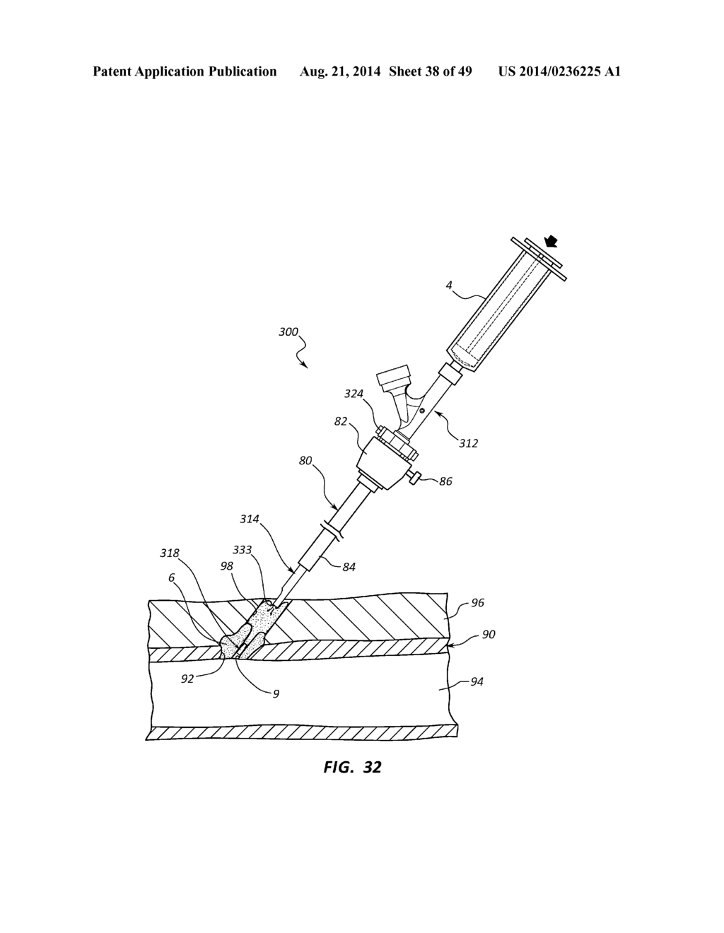 BIOADHESIVE DELIVERY SYSTEMS AND METHODS FOR VASCULAR CLOSURE - diagram, schematic, and image 39