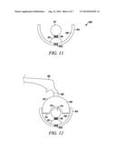 REVERSE JOINT REPLACEMENT DEVICE AND METHODS THEREOF diagram and image