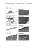 METHODS FOR TREATING UV-DAMAGED SKIN AND SCC TUMORS AND FOR REMOVING     TATTOOS WITH TOPICAL INGENOL MEBUTATE diagram and image