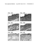 METHODS FOR TREATING UV-DAMAGED SKIN AND SCC TUMORS AND FOR REMOVING     TATTOOS WITH TOPICAL INGENOL MEBUTATE diagram and image