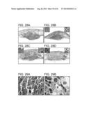 METHODS FOR TREATING UV-DAMAGED SKIN AND SCC TUMORS AND FOR REMOVING     TATTOOS WITH TOPICAL INGENOL MEBUTATE diagram and image