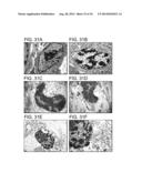 METHODS FOR TREATING UV-DAMAGED SKIN AND SCC TUMORS AND FOR REMOVING     TATTOOS WITH TOPICAL INGENOL MEBUTATE diagram and image