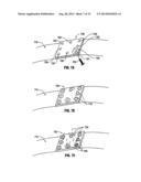 Hydrogel Implants with Varying Degrees of Crosslinking diagram and image