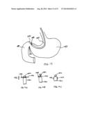 Hydrogel Implants with Varying Degrees of Crosslinking diagram and image