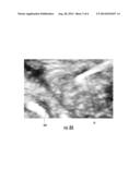 COLOR ULTRASOUND NEEDLE diagram and image