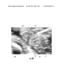 COLOR ULTRASOUND NEEDLE diagram and image