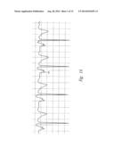 Method of Locating the Tip of a Central Venous Catheter diagram and image