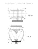 Extracorporeal Pressure Shock Wave Devices with Multiple Reflectors and     Methods for Using these Devices diagram and image