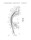 METHOD AND APPARATUS FOR REDUCING INTRAOCULAR PRESSURE OF AN EYE diagram and image