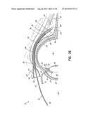 METHOD AND APPARATUS FOR REDUCING INTRAOCULAR PRESSURE OF AN EYE diagram and image