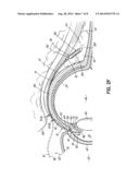 METHOD AND APPARATUS FOR REDUCING INTRAOCULAR PRESSURE OF AN EYE diagram and image