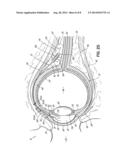 METHOD AND APPARATUS FOR REDUCING INTRAOCULAR PRESSURE OF AN EYE diagram and image