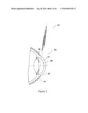 INTRAOCULAR SHUNT IMPLANTATION METHODS AND DEVICES diagram and image