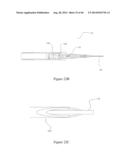 INTRAOCULAR SHUNT IMPLANTATION METHODS AND DEVICES diagram and image