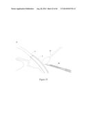 INTRAOCULAR SHUNT IMPLANTATION METHODS AND DEVICES diagram and image