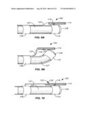 AUTO-ALIGNING ABLATING DEVICE AND METHOD OF USE diagram and image