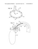 SHOCK WAVE BALLOON CATHETER WITH MULTIPLE SHOCK WAVE SOURCES diagram and image