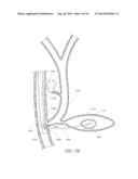 RATCHET-SLIDE HANDLE AND SYSTEM FOR FIDUCIAL DEPLOYMENT diagram and image