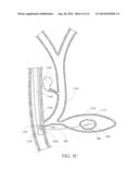 RATCHET-SLIDE HANDLE AND SYSTEM FOR FIDUCIAL DEPLOYMENT diagram and image