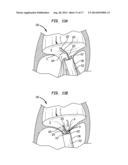 APPARATUS AND METHOD FOR HEART VALVE REPAIR diagram and image