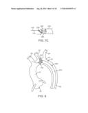 Embolic Protection Device diagram and image