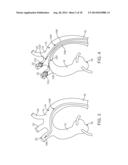 Embolic Protection Device diagram and image