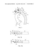 Embolic Protection Device diagram and image