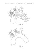 Embolic Protection Device diagram and image