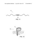 TISSUE PROTECTOR SUTURE CONSTRUCTS diagram and image